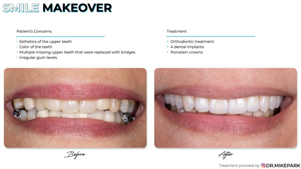 Before and after 4 dental implants and porcelain crowns treatment