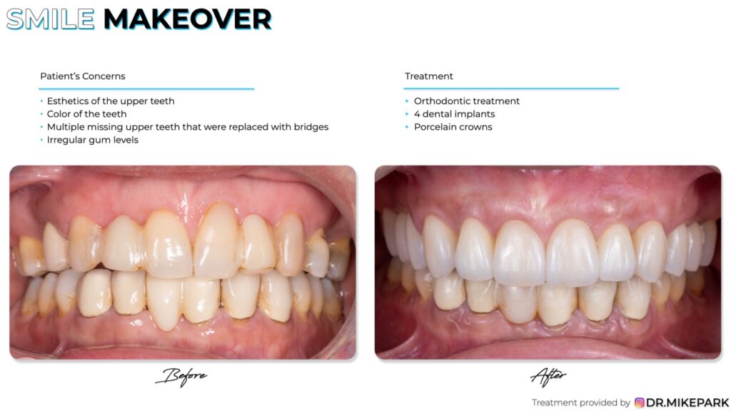 Before and after 4 dental implants treatment