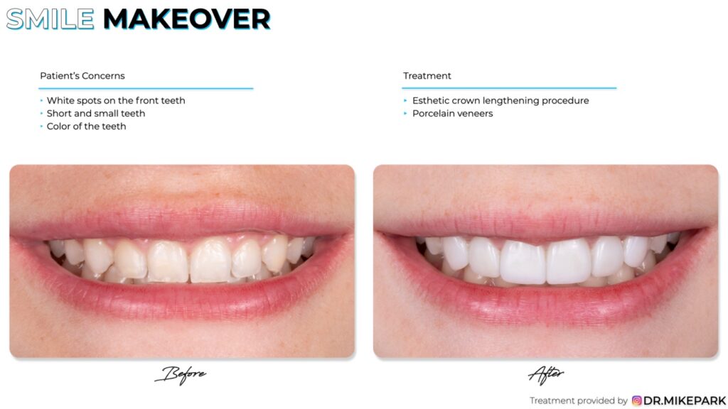 Before and after aesthetic crown lengthening and porcelain veneers procedure