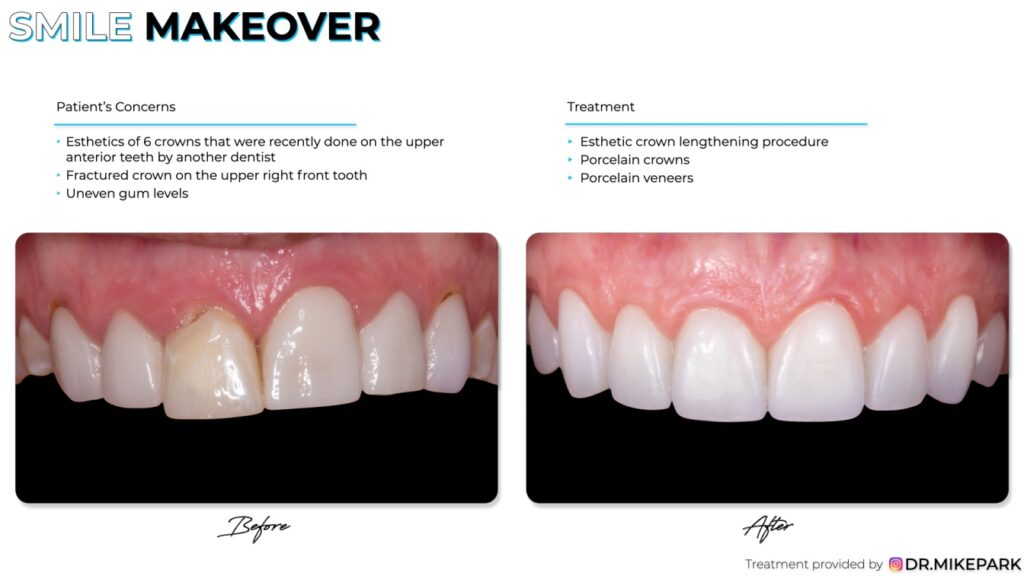Before and after aaesthetic crown lengthening procedure
