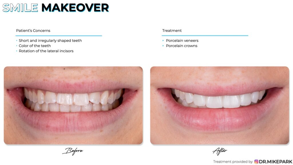 Before and after porcelain crowns and porcelain veneers treatment
