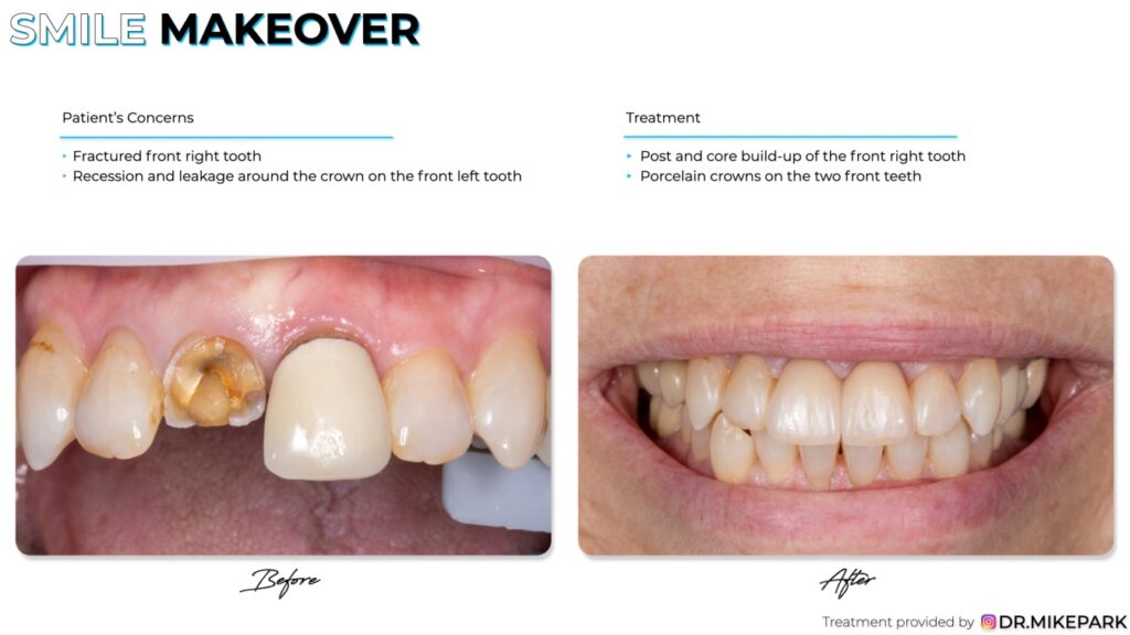 Before and after porcelain crowns on the two front teeth treatment