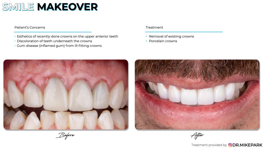 Before and after removal of existing crowns treatment