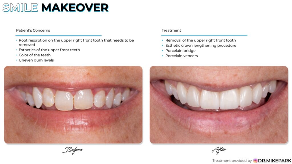 Before and after removal of the upper right front tooth