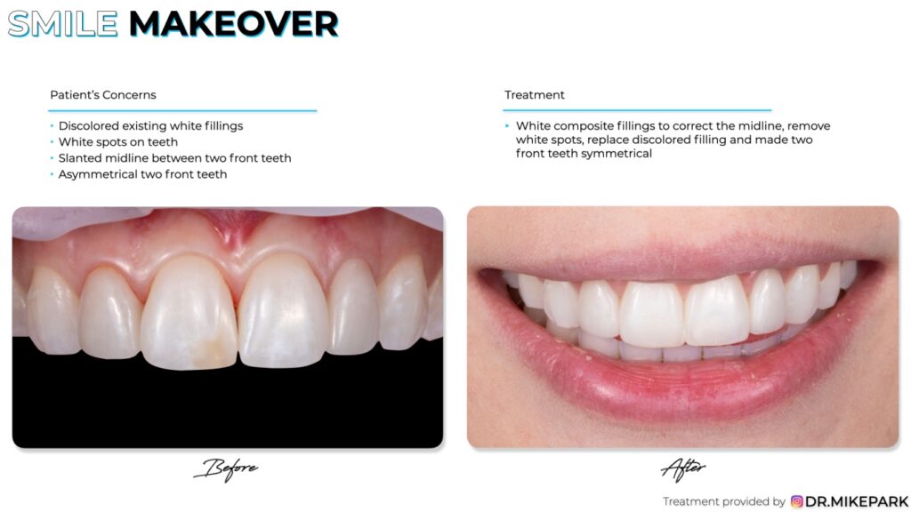 Before and after white composite fillings treatment
