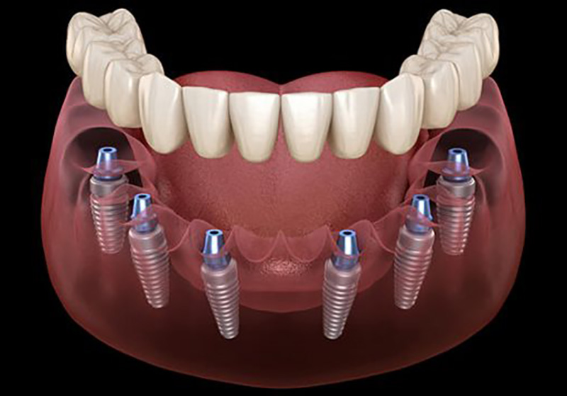 Implant-Supported Dentures Near You
